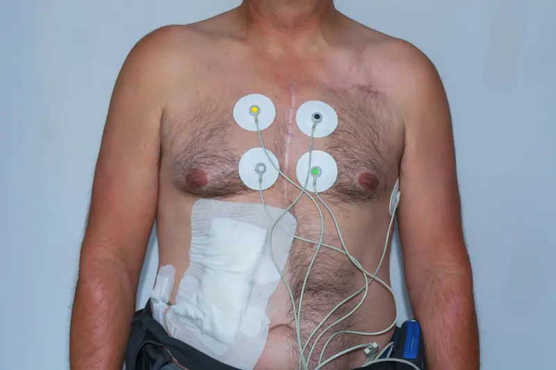 LVAD Heart Pump Life Expectancy Explained